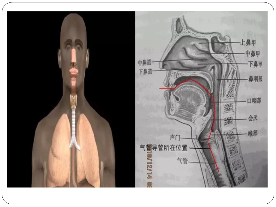 气管切开病人术后护理.pptx_第3页