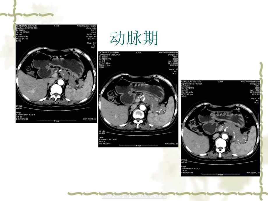 消化系统神经内分泌癌.ppt_第3页