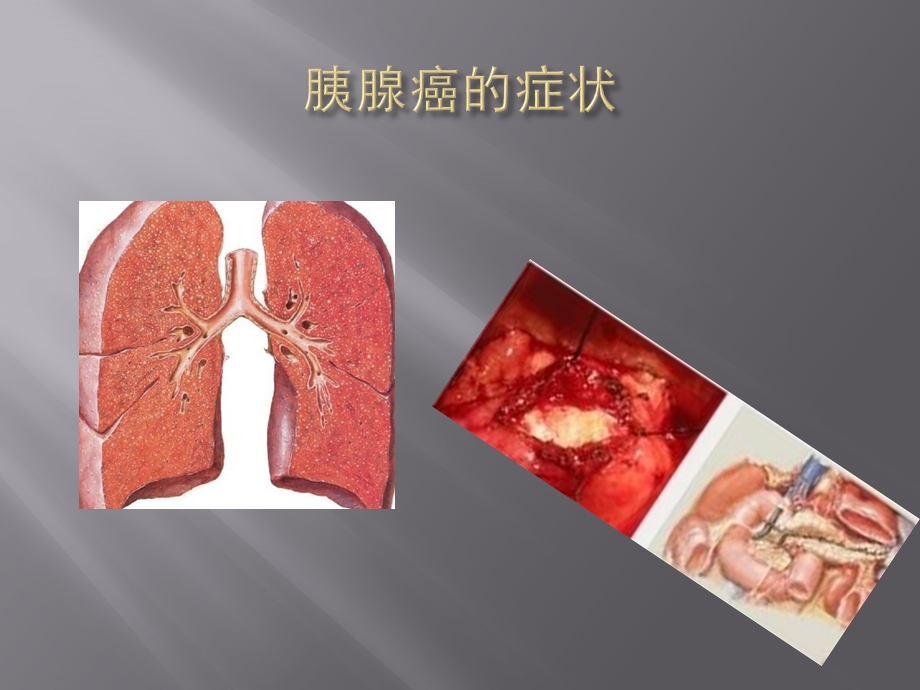 胰腺癌的症状及诊断方法.pptx_第3页