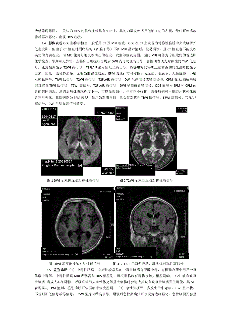 脑桥外髓鞘溶解症一例MRI表现并文献复习李春燕韩昊.docx_第3页