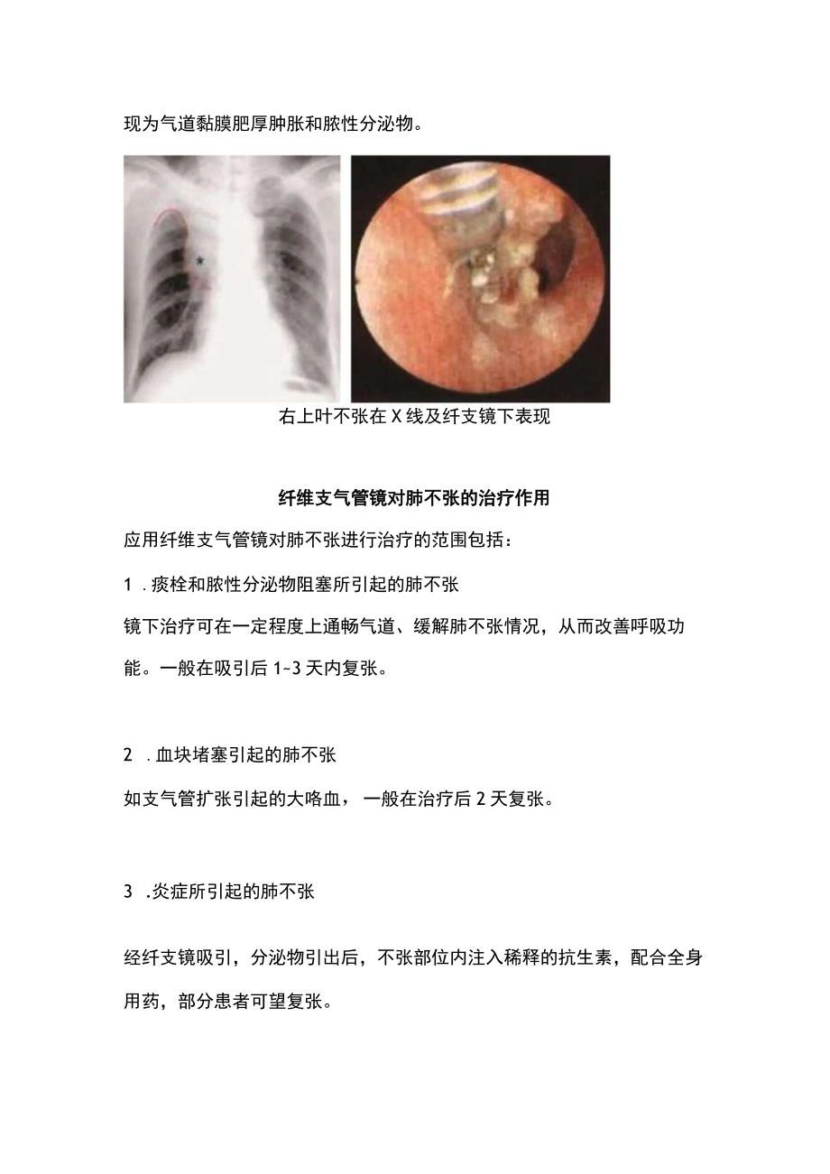 2023支气管镜之肺不张的诊断和治疗.docx_第2页