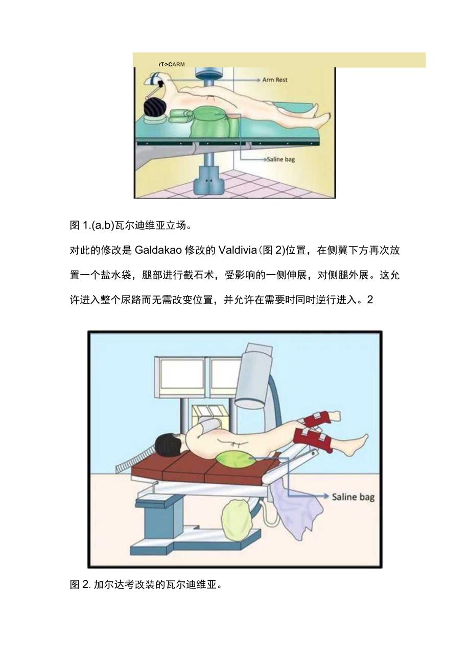 2023仰卧位经皮肾镜取石术.docx_第3页