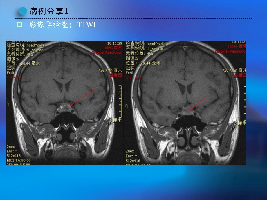 朗格汉斯细胞组织细胞增生症.pptx_第3页