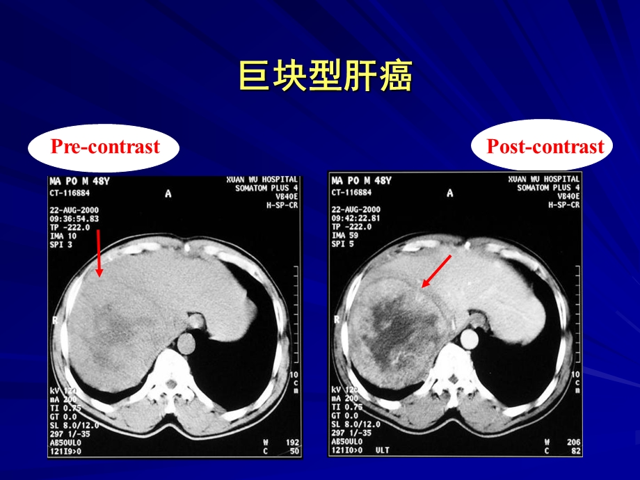 肝脏肿瘤诊断.ppt_第2页