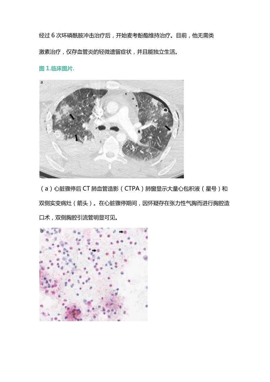 ANCA阴性的ANCA相关性血管炎2024.docx_第3页