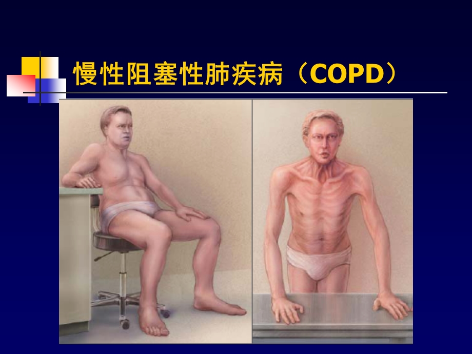 COPD一种伴有异常炎症反应的多因素构成的疾病.ppt_第1页