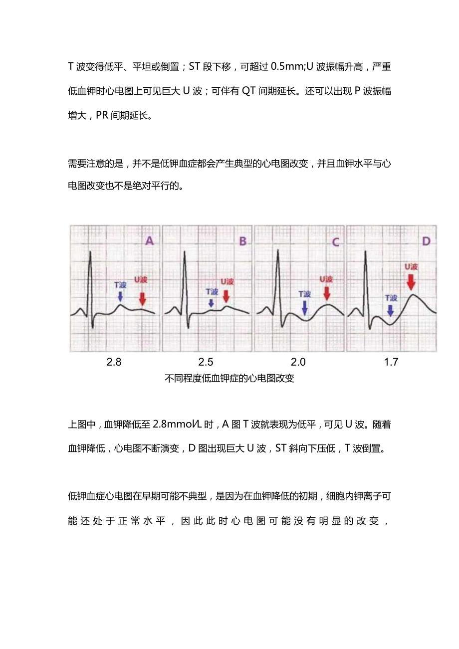 2024低钾血症的诊疗思路.docx_第2页