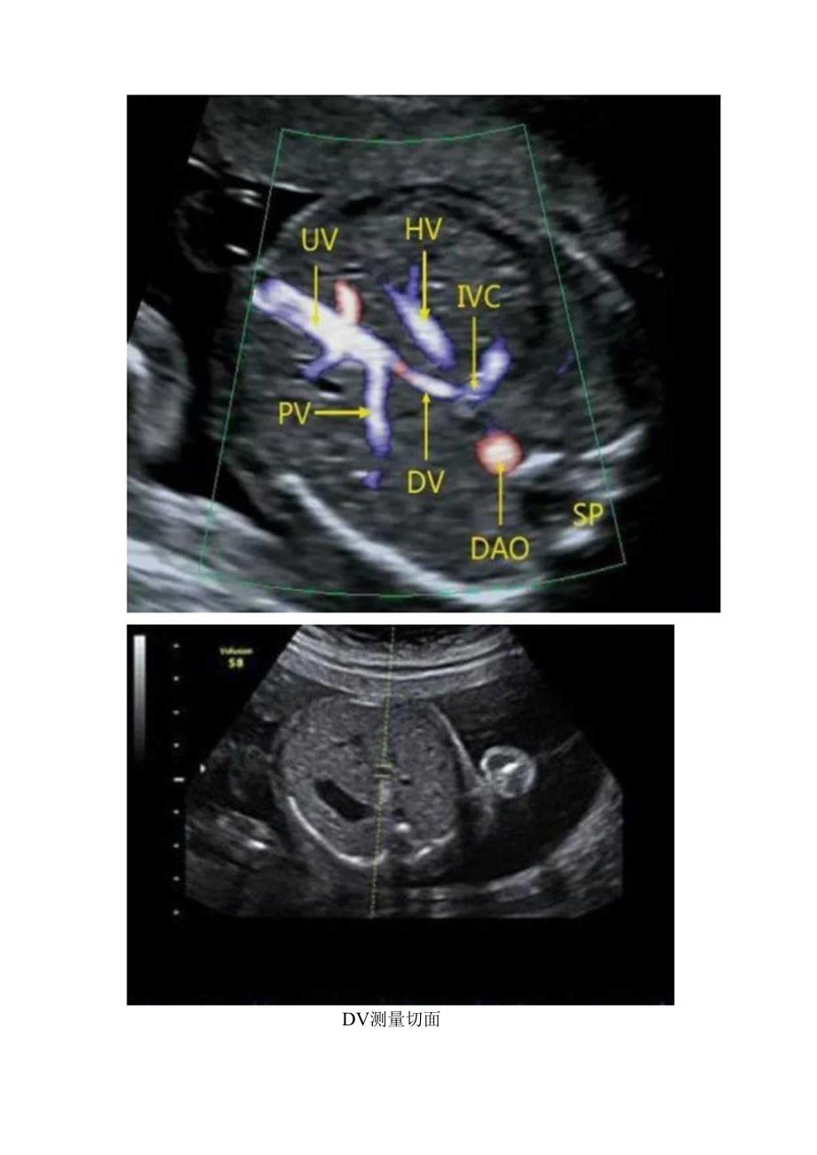 胎儿静脉导管血流频谱及临床意义.docx_第2页