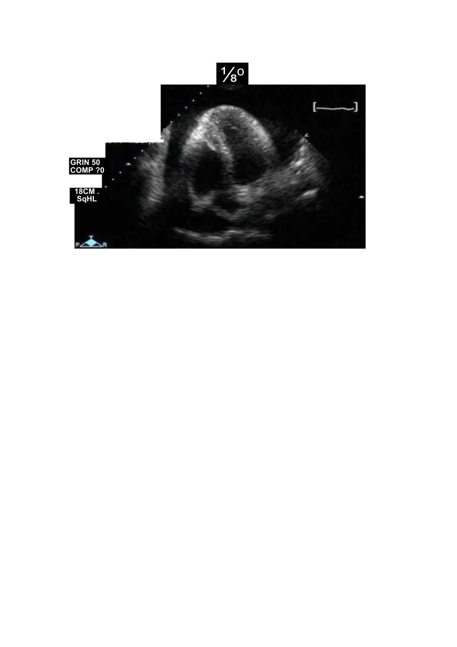 心包积液定量诊断依据、出现部位及影像表现.docx_第2页
