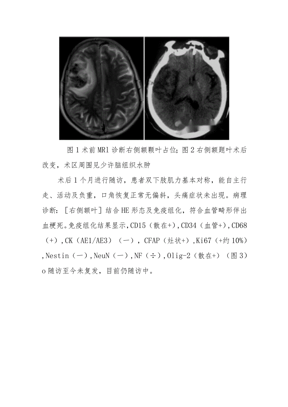 神经内科似脑胶质细胞瘤的脑梗死病例报告专题报告.docx_第3页