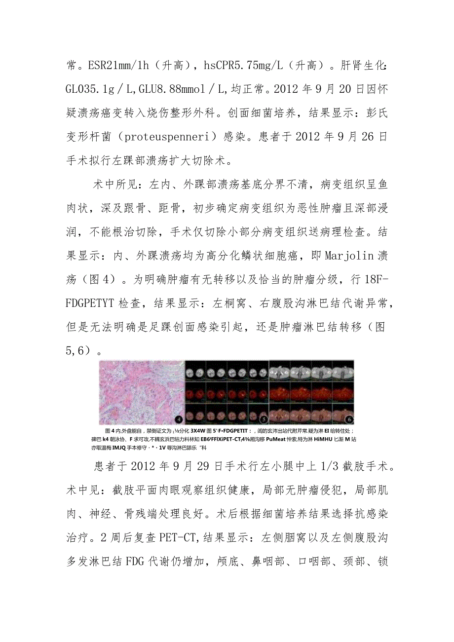 烧伤科内外踝Marjolin溃疡病例分析.docx_第3页