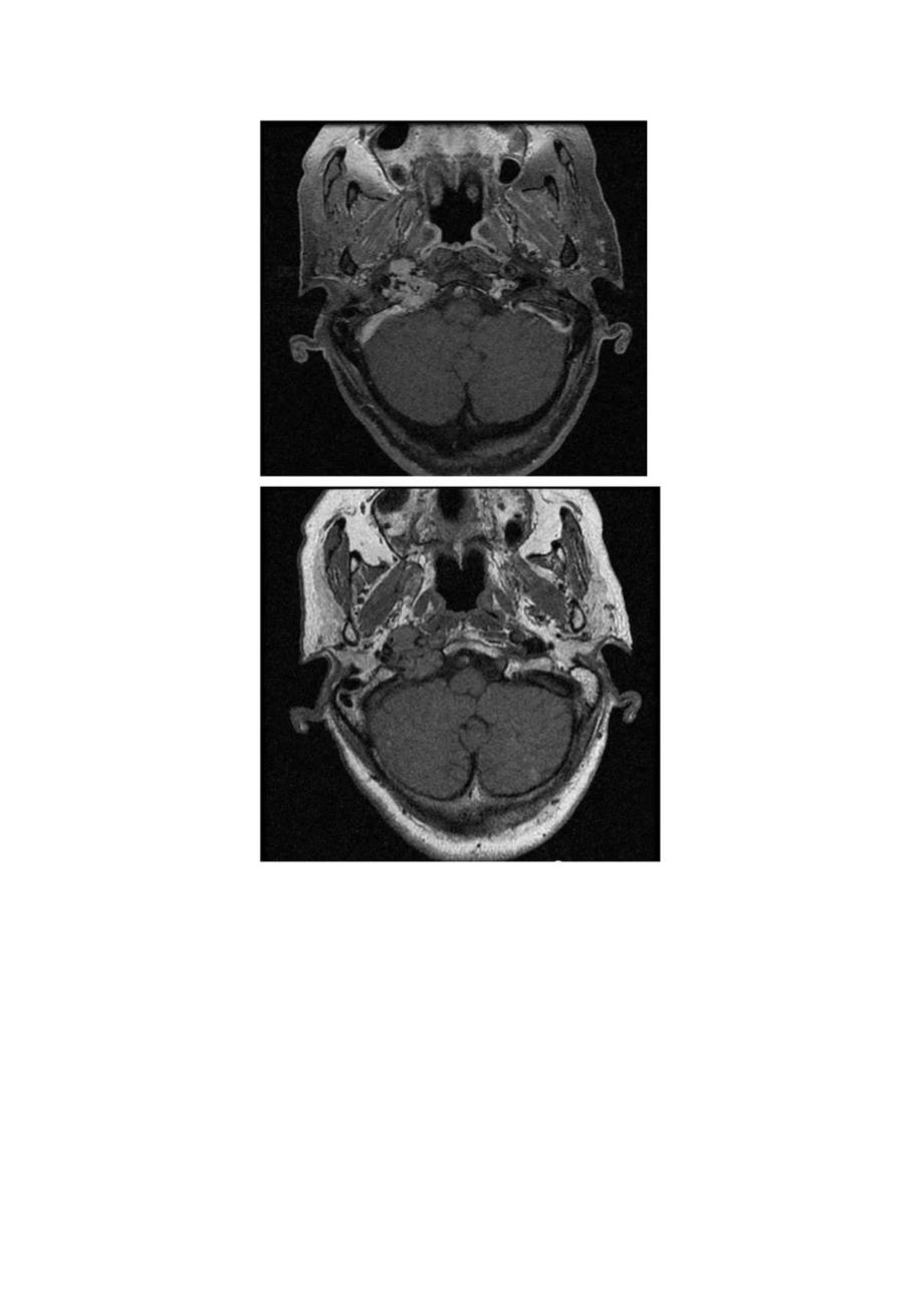 胡椒盐征影像表现、临床病理及鉴别诊断.docx_第2页