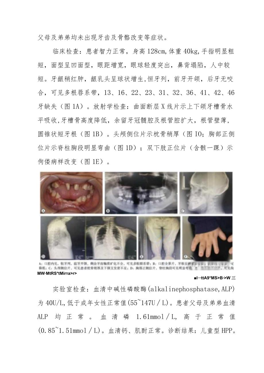 内科低磷酸酯酶症家系病例分析专题报告.docx_第2页