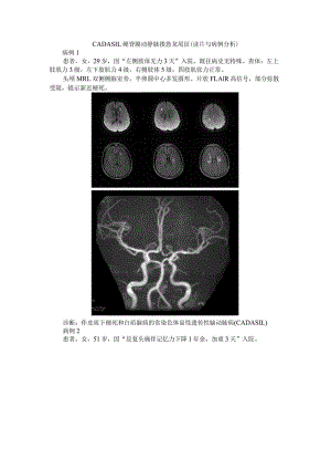 CADASIL 硬脊膜动静脉瘘 恐龙尾征(读片与病例分析).docx