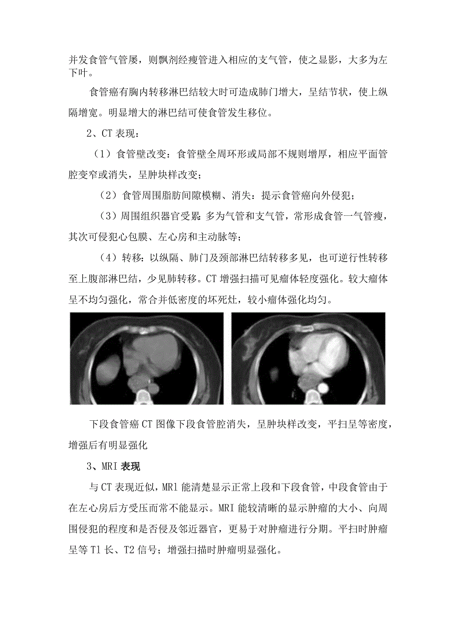 食管癌临床表现及影像学表现.docx_第3页