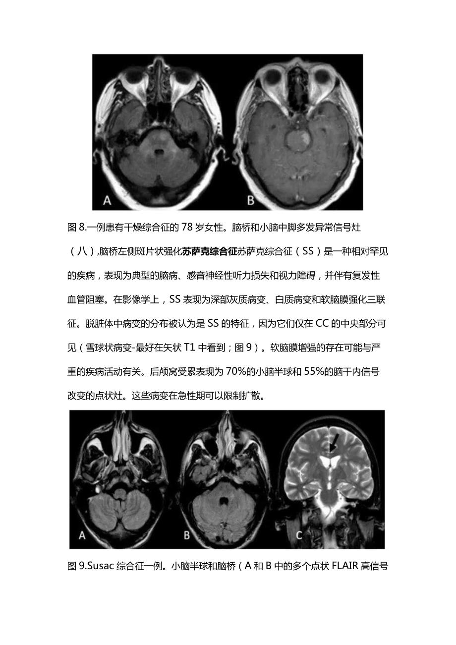 2024非感染性脑干脑炎神经影像学表现（第二部分）.docx_第2页