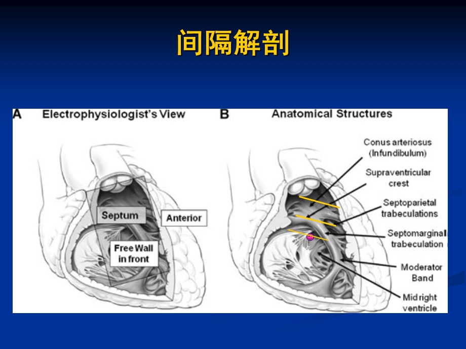 右心室间隔部起搏tool and skill.ppt_第3页