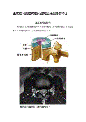 正常椎间盘结构椎间盘突出分型影像特征.docx