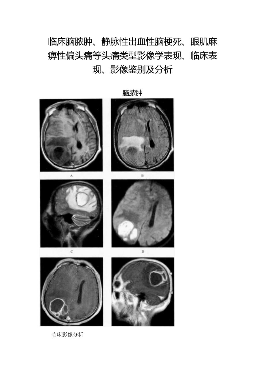 临床脑脓肿、静脉性出血性脑梗死、眼肌麻痹性偏头痛等头痛类型影像学表现、临床表现、影像鉴别及分析.docx_第1页