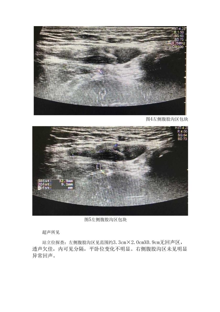 临床子宫圆韧带囊肿病例、病因、临床表现、超声表现、鉴别诊断及圆韧带子宫内膜异位症治疗要点.docx_第3页