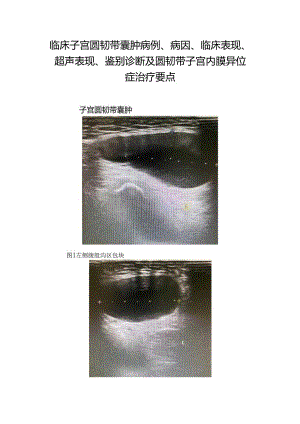 临床子宫圆韧带囊肿病例、病因、临床表现、超声表现、鉴别诊断及圆韧带子宫内膜异位症治疗要点.docx