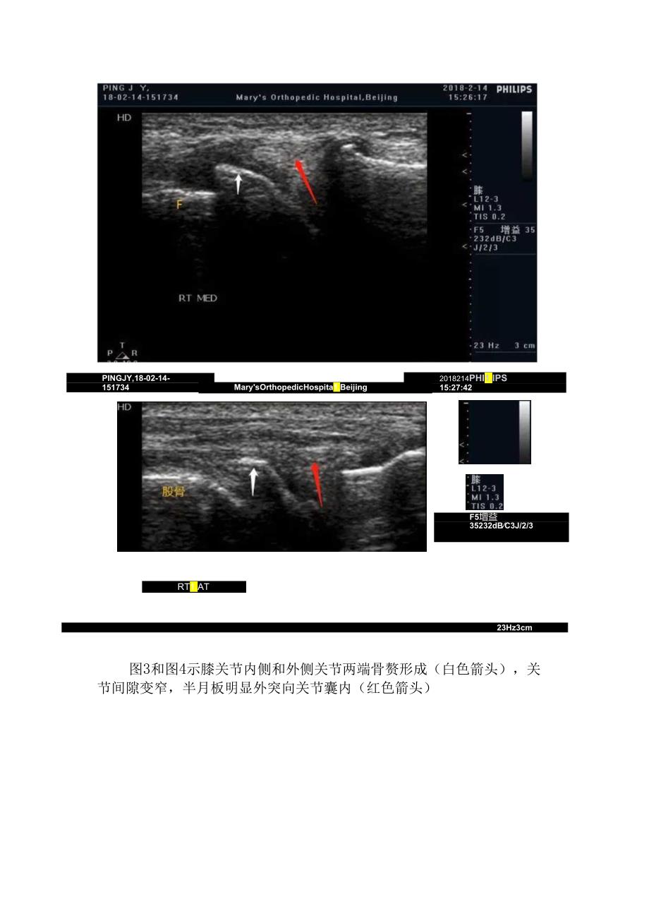 临床膝关节骨性关节炎病理、超声检查、病例分享及注意鉴别要点.docx_第3页