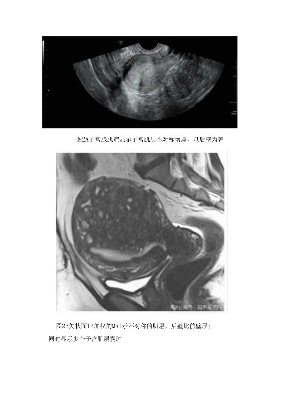 临床子宫腺肌症超声表现、诊断及鉴别诊断.docx_第2页