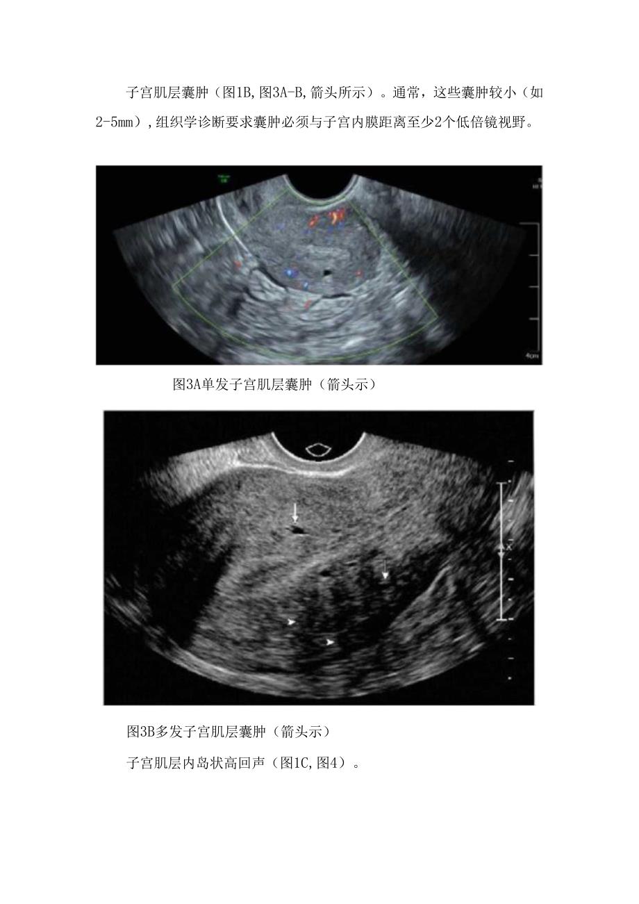 临床子宫腺肌症超声表现、诊断及鉴别诊断.docx_第3页