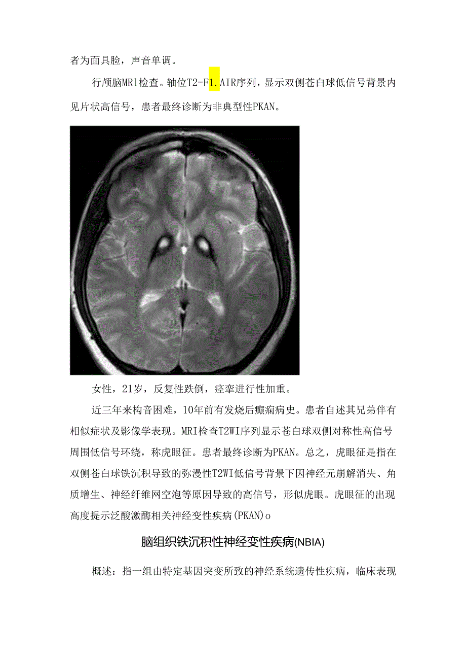 临床脑组织铁沉积性神经变性疾病虎眼征影像学征象、病理及疾病鉴别 - 副本.docx_第3页