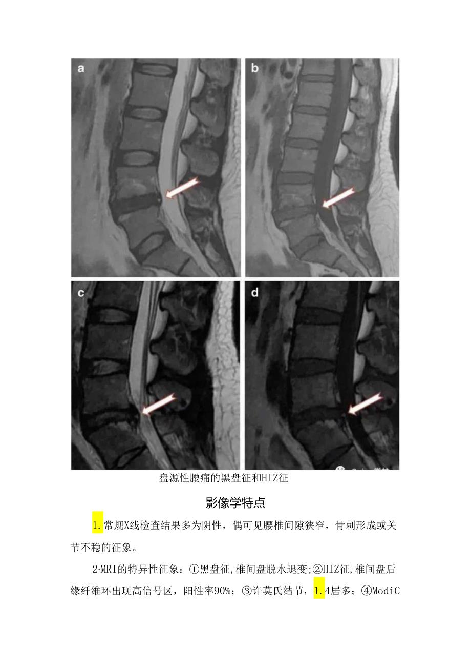 盘源性腰痛的发病机制、临床表现、影像学特点及治疗进展.docx_第3页