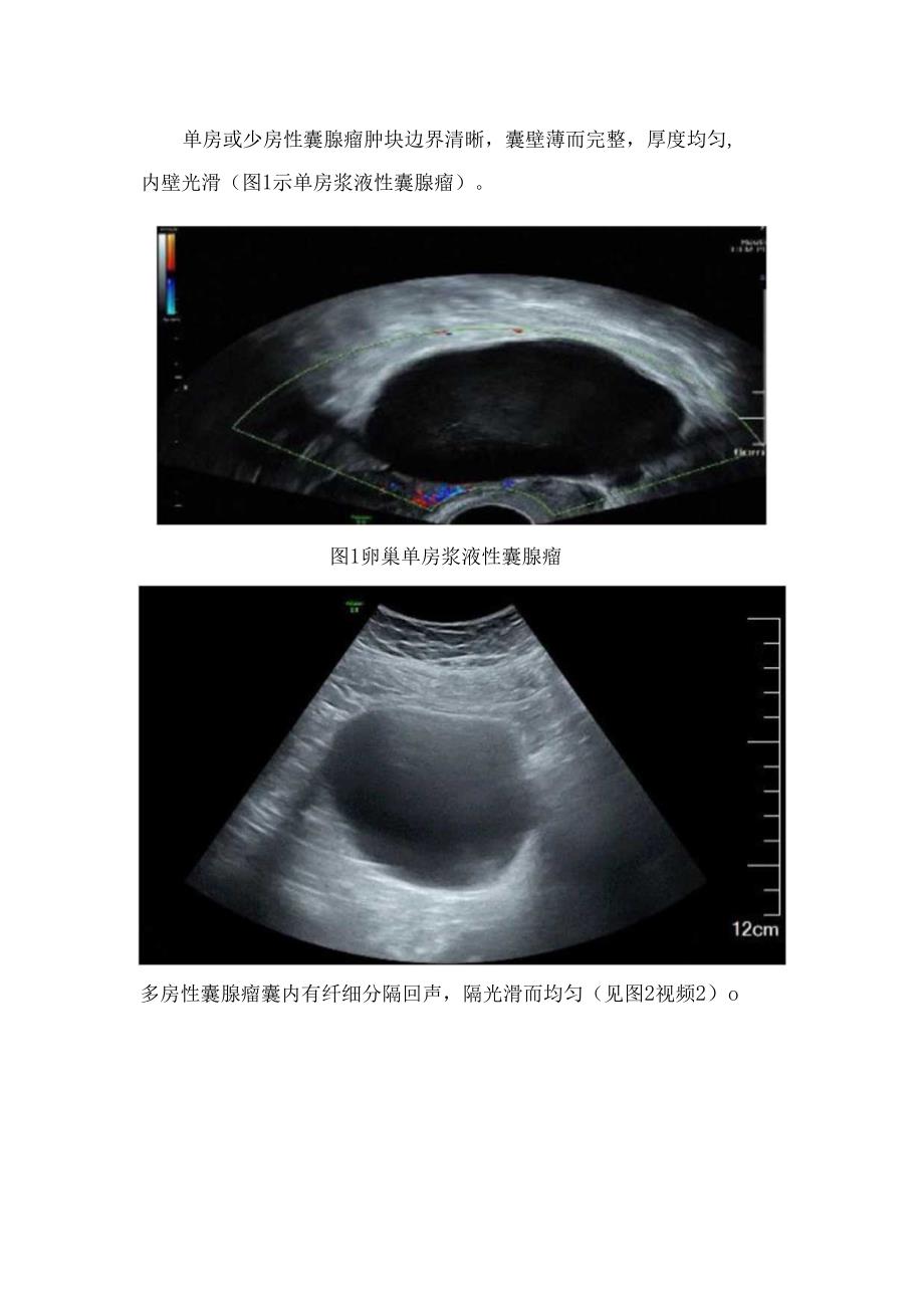 临床卵巢囊腺瘤高发人群、临床表现、病理、超声表现及注意事项.docx_第2页