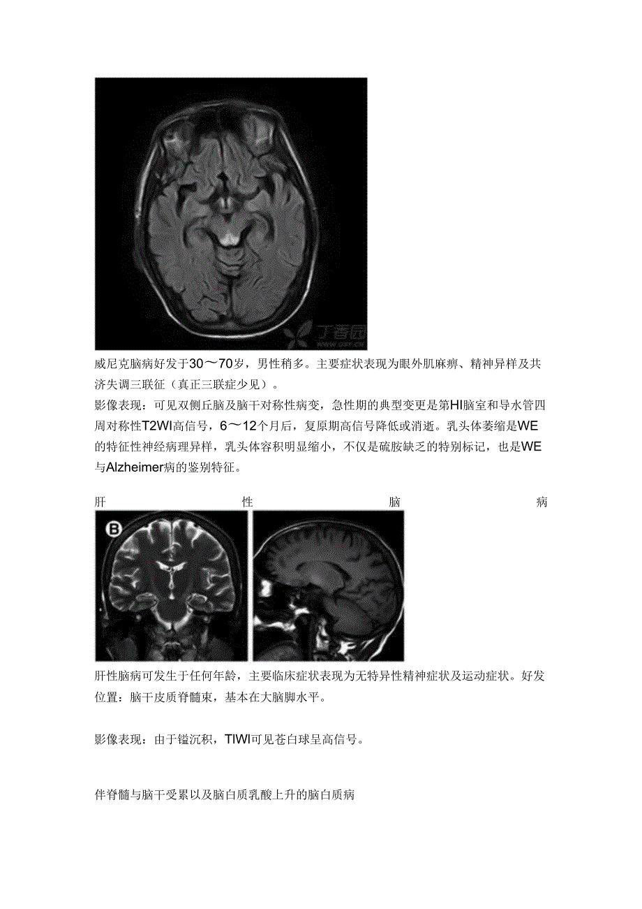 30张图理清脑干病变(代谢炎症篇).docx_第3页