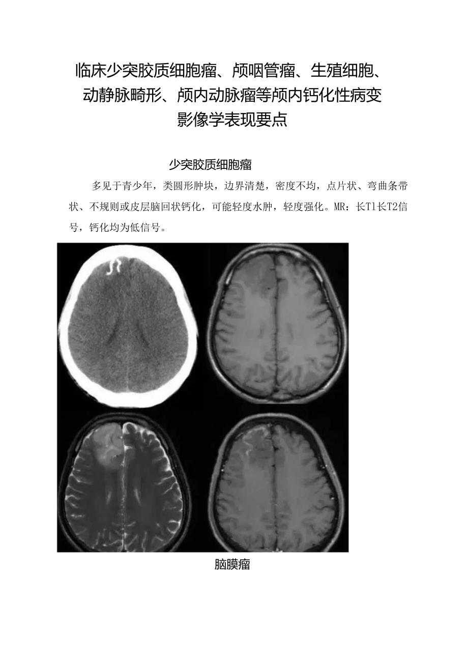 临床少突胶质细胞瘤、颅咽管瘤、生殖细胞、动静脉畸形、颅内动脉瘤等颅内钙化性病变影像学表现要点.docx_第1页