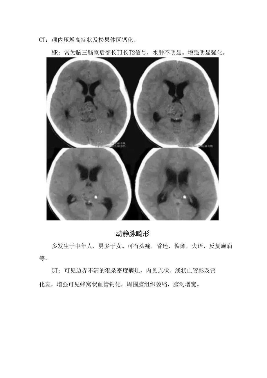 临床少突胶质细胞瘤、颅咽管瘤、生殖细胞、动静脉畸形、颅内动脉瘤等颅内钙化性病变影像学表现要点.docx_第3页
