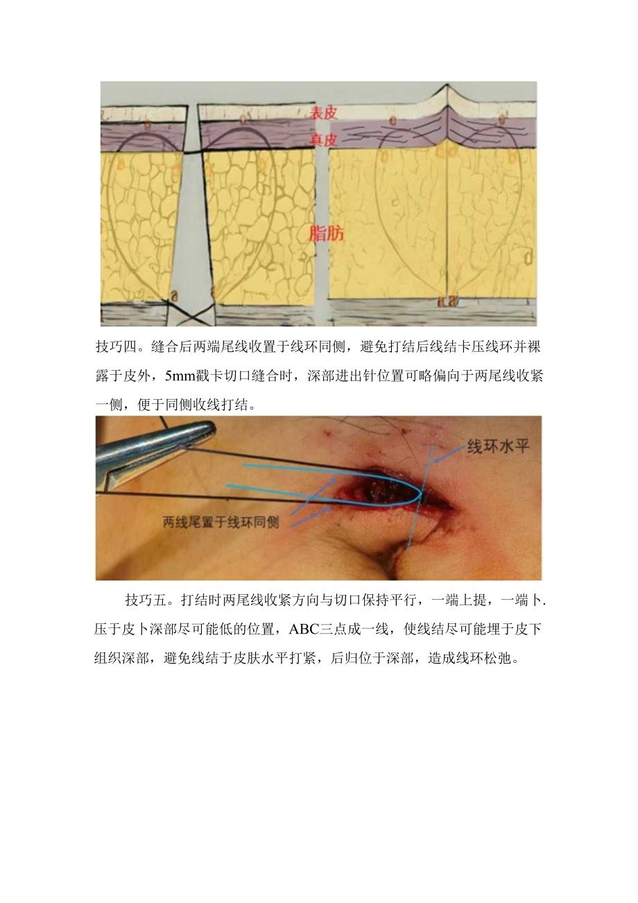 临床腹腔镜戳卡切口皮下缝合技巧要点.docx_第2页