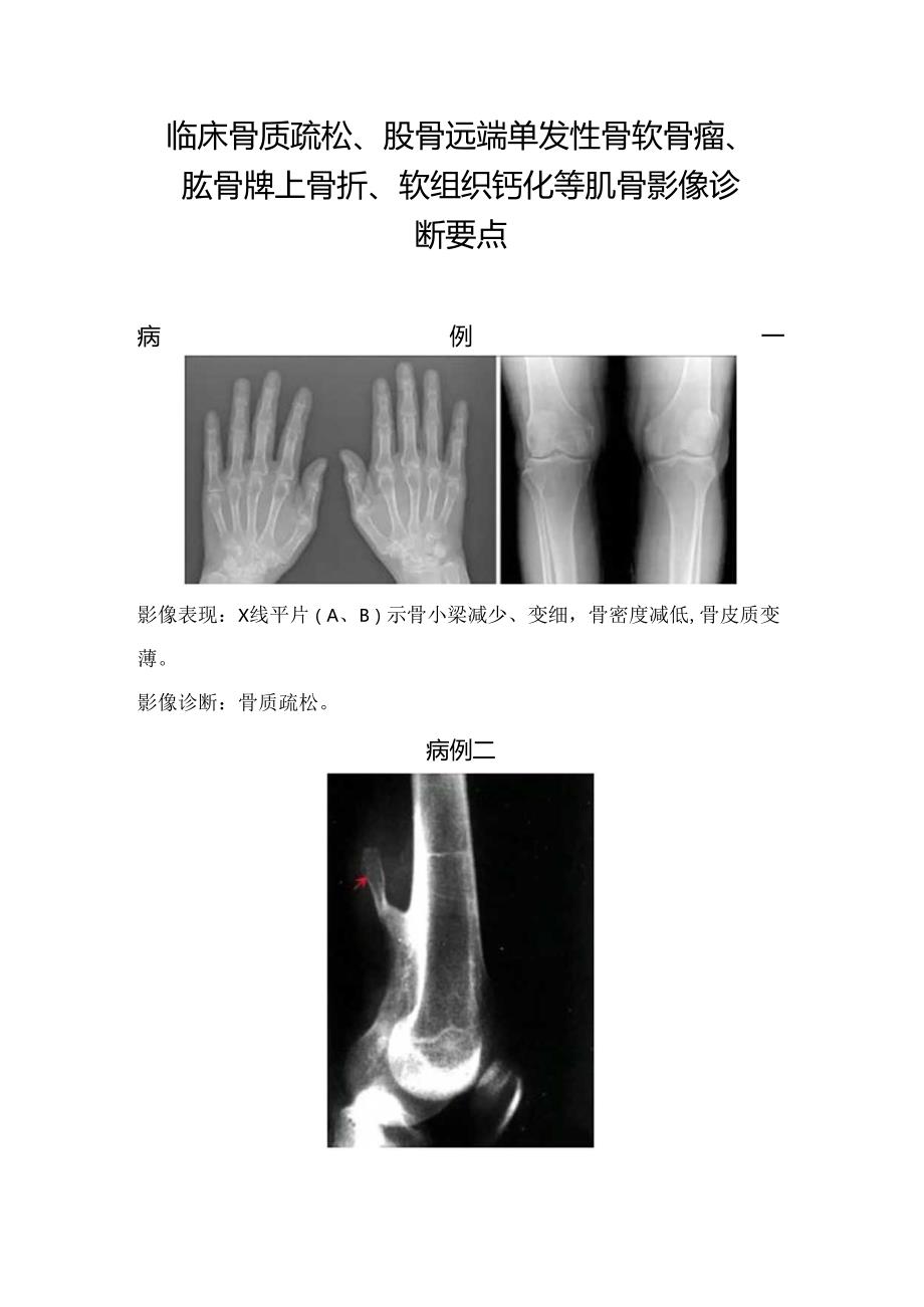 临床骨质疏松、股骨远端单发性骨软骨瘤、肱骨髁上骨折等肌骨影像诊断要点.docx_第1页