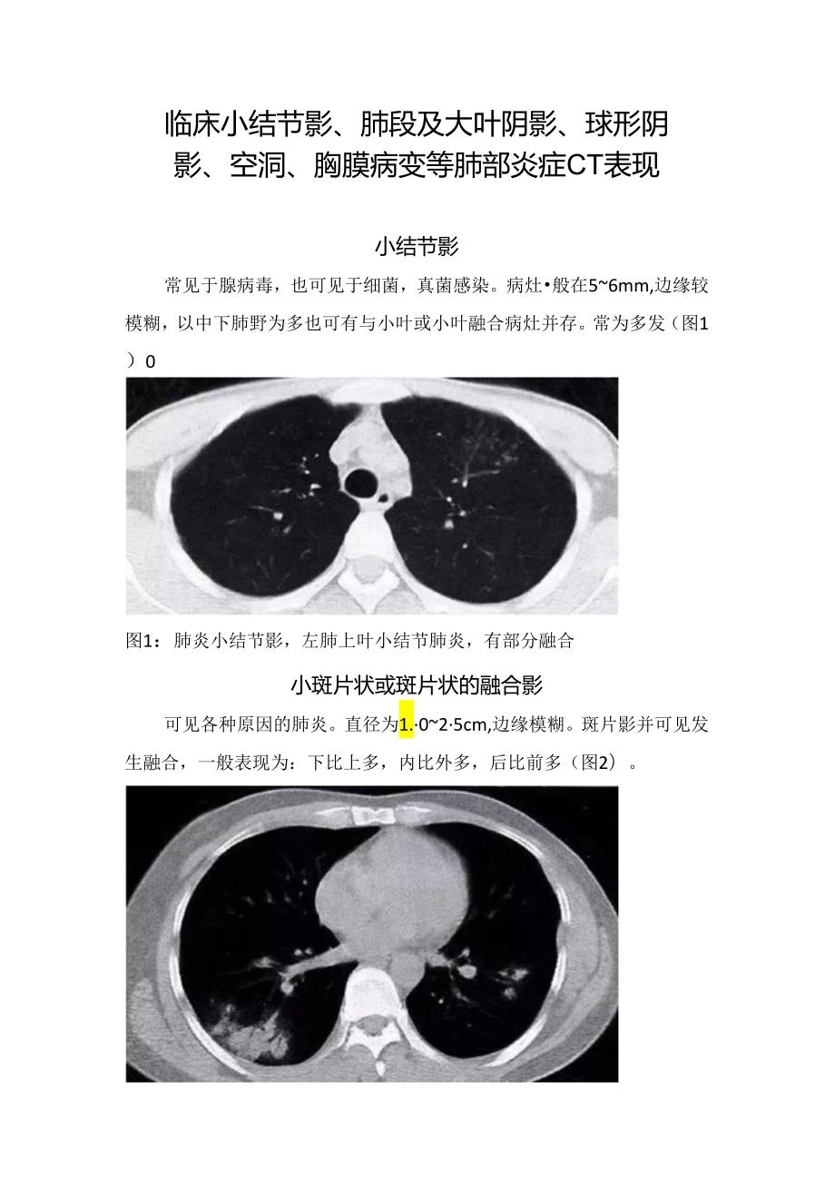 临床小结节影、 肺段及大叶阴影、球形阴影、空洞、胸膜病变等肺部炎症CT表现.docx_第1页