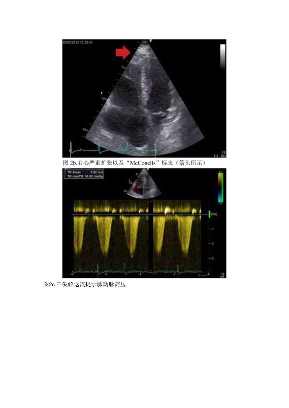 超声心动图排除非ST段抬高型心肌梗死（心脏超声造影诊断非ST段抬高型心肌梗死患者梗死相关血管的应用）.docx_第3页