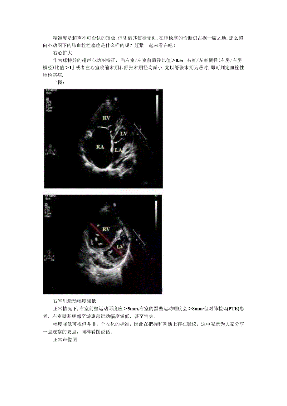 超声心动图九大征象看肺动脉栓塞与超声鉴别诊断要点.docx_第1页